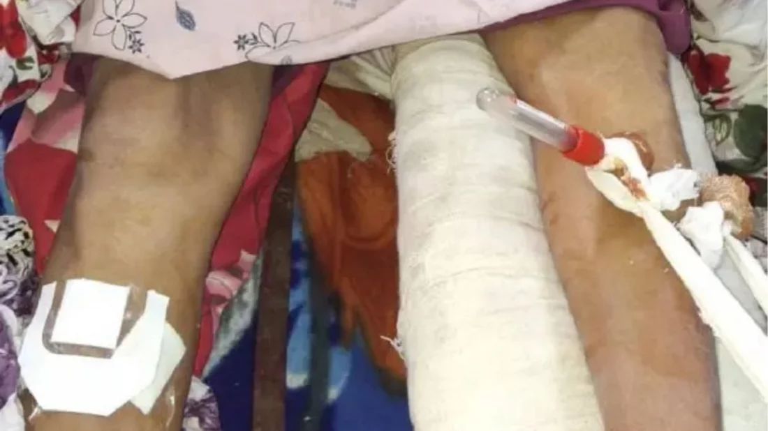 বাঁ পায়ের হাড় ভেঙে যাওয়া রোগীর ডান পায়ে অপারেশন করলো ডাক্তার